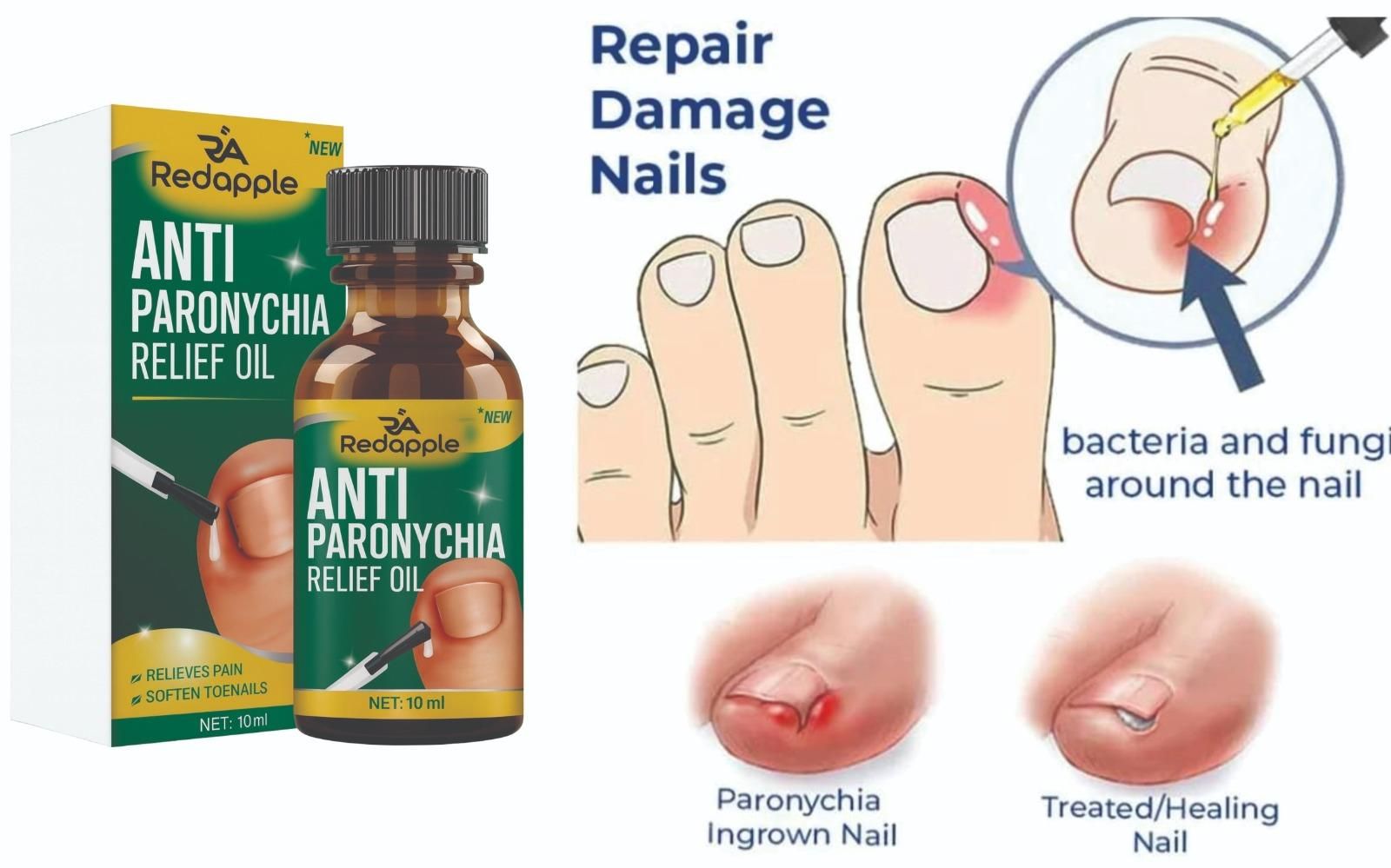 Anti Paronychia Relief Oil 20 ml Pack of 2 - OSAK ENTERPRISES